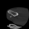 SPORK, NICO - 22.03.1976 - 02.08.2022 - CT obere Extremität - 17:51:17